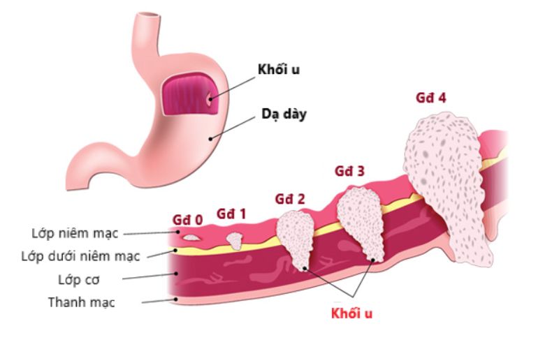 Nguyên nhân dẫn đến ung thư dạ dày