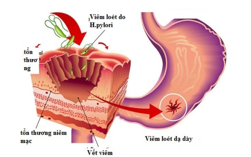 Thông tin về chứng <yoastmark class=