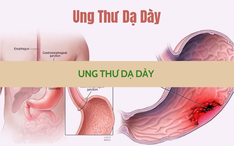 Bệnh ung thư dạ dày