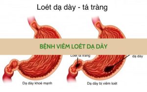 Viêm loét dạ dày
